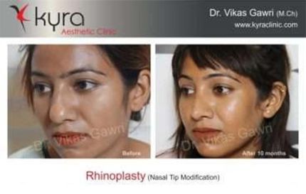 Rhinoplasty Nasal Tip Modification