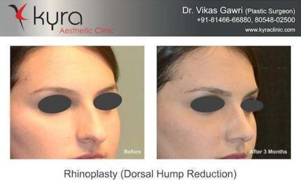 Rhinoplasty Nose Surgery 