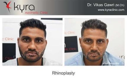 Rhinoplasty Nose Surgery in Ludhiana