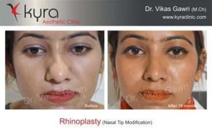 Rhinoplasty Result After Just Weeks