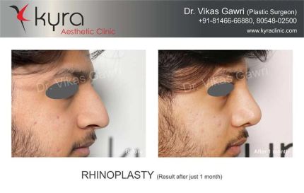 Rhinoplasty Result After Just Weeks