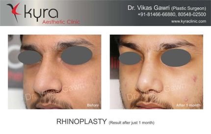 Rhinoplasty Result After Just Weeks