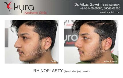 Rhinoplasty Result After Just Weeks