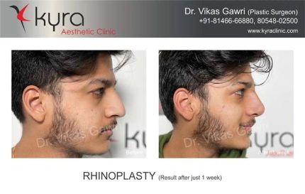 Rhinoplasty Result After Just Weeks