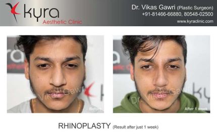 Rhinoplasty Result After Just Weeks