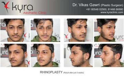 Rhinoplasty Result After Just Weeks