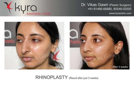 Rhinoplasty Result After Just Weeks