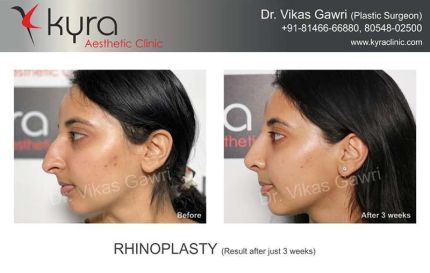 Rhinoplasty Result After Just Weeks