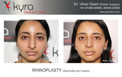 Rhinoplasty Result After Just Weeks