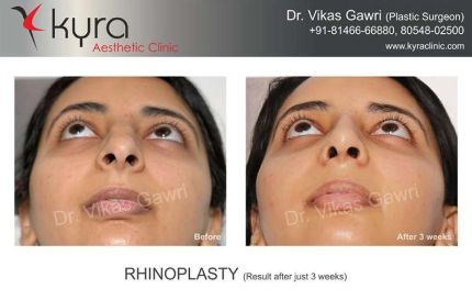 Rhinoplasty Result After Just Weeks