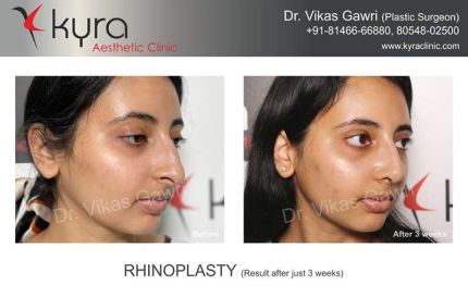 Rhinoplasty Result After Just Weeks