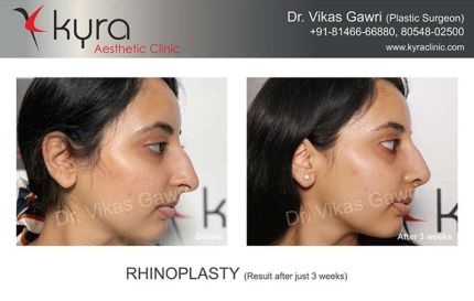 Rhinoplasty Result After Just weeks