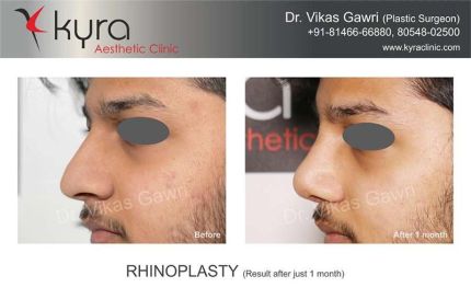 Rhinoplasty-Result-after-just-1-month