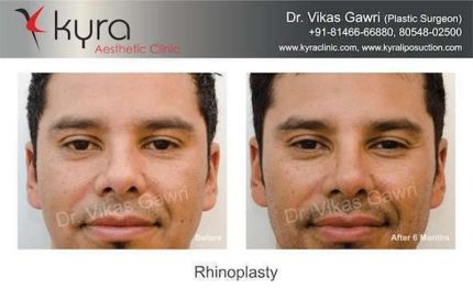 Rhinoplasty