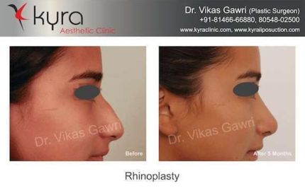 Rhinoplasty