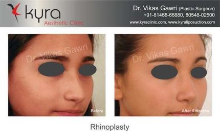 Rhinoplasty