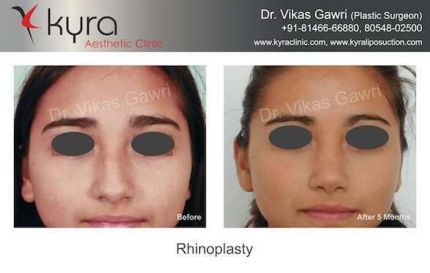 Rhinoplasty