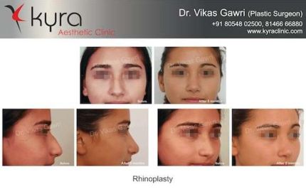 Rhinoplasty