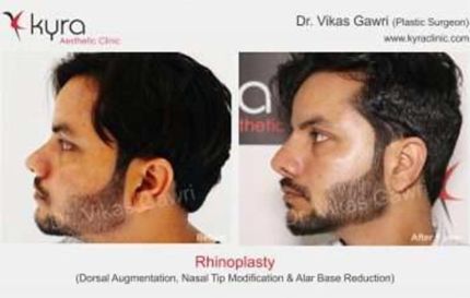 Rhinoplasty