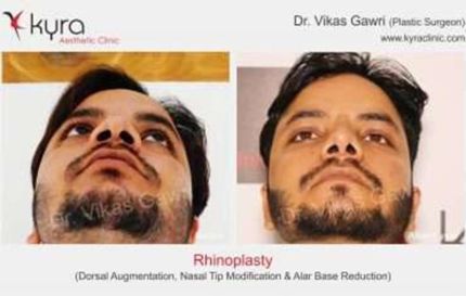 Rhinoplasty