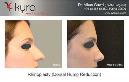 Rhinoplasty