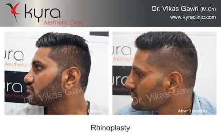 Rhinoplasty