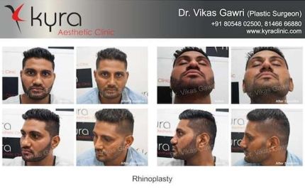 Rhinoplasty