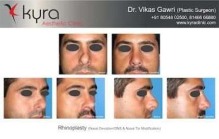 Rhinoplasty