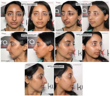 Septo Rhinoplasty Before After Three Weeks