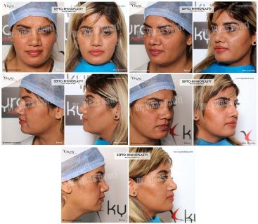 Septo Rhinoplasty