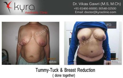 Tummy Tuck Breast Reduction 