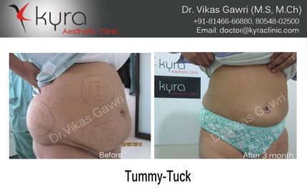 Tummy Tuck