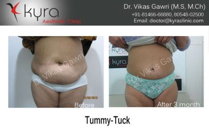 Tummy Tuck