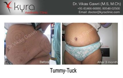 Tummy Tuck