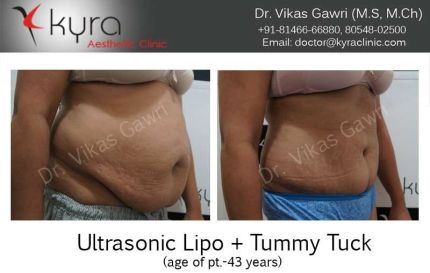 Ultrasonic Lipo Tummy Tuck