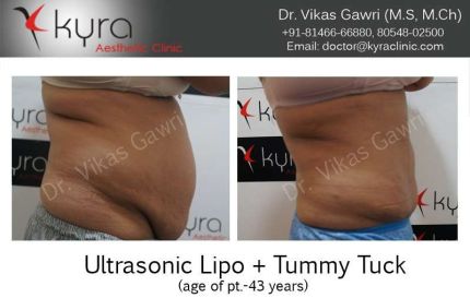 Ultrasonic Lipo Tummy Tuck