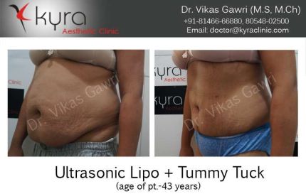 Ultrasonic Lipo Tummy Tuck