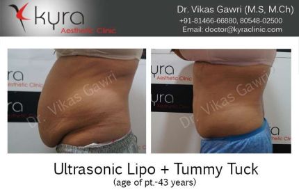 Ultrasonic Lipo Tummy Tuck