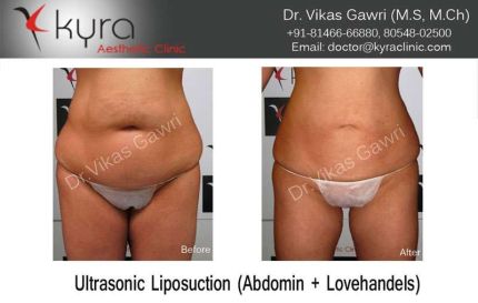 Ultrasonic Liposuction Abdomen Love handels