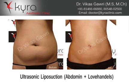 Ultrasonic Liposuction Abdomen Love handels