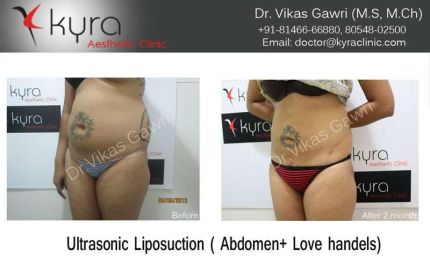 Ultrasonic Liposuction Abdomen Love handels