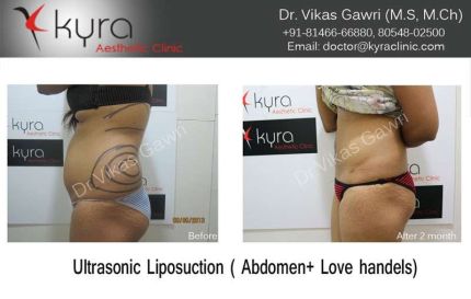 Ultrasonic Liposuction Abdomen Love handels