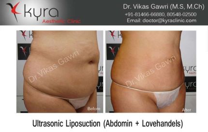 Ultrasonic Liposuction Abdomen Lovehandels