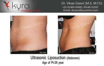 Ultrasonic Liposuction Abdomen