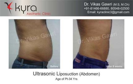 Ultrasonic Liposuction Abdomen