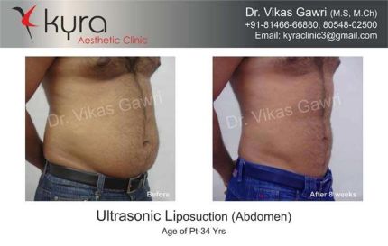 Ultrasonic Liposuction Abdomen