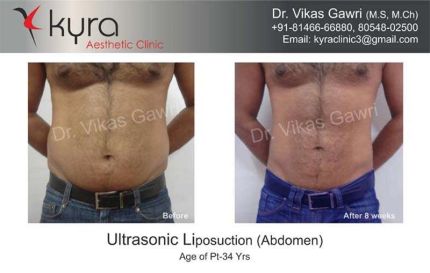 Ultrasonic Liposuction Abdomen