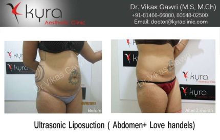 Ultrasonic Liposuction Abdomin Love handels