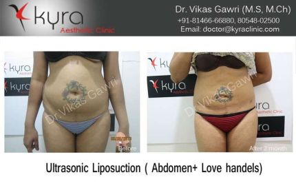 Ultrasonic Liposuction Abdomin Love handels