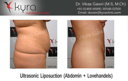 Ultrasonic Liposuction Abdomin Lovehandels